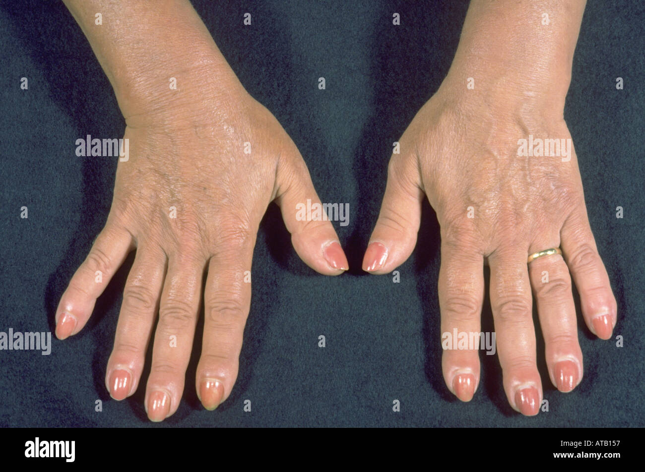 Finger clubbing secondary to lung cancer Stock Photo
