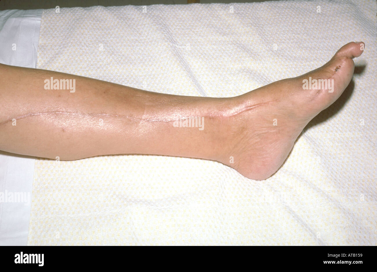 Vascular bypass surgery leg Stock Photo