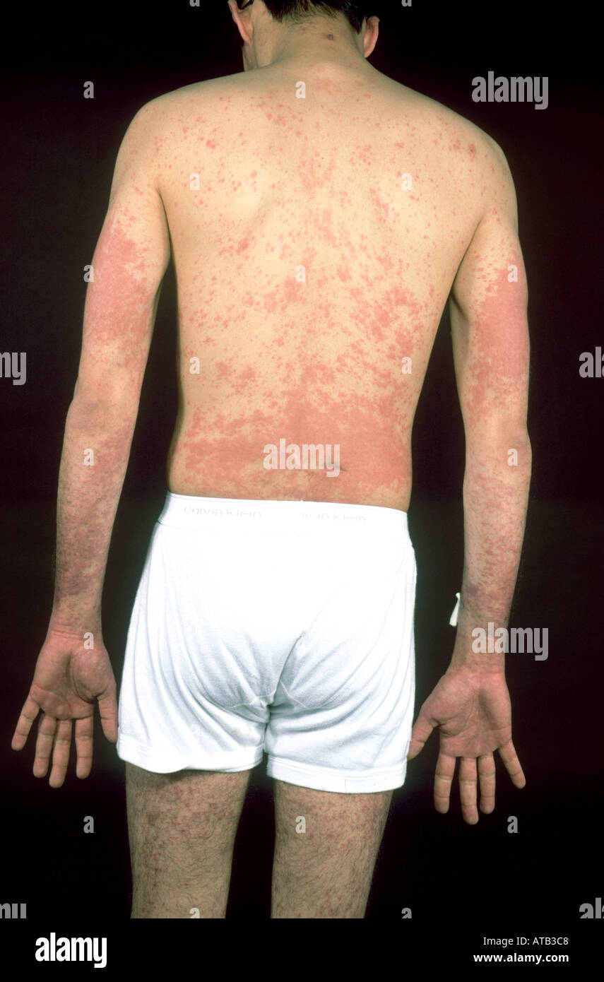 Hypersensitivity rash hires stock photography and images Alamy