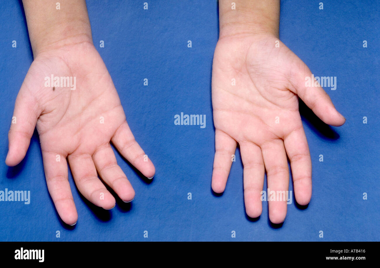 Post streptococcal glomerulonephritis Stock Photo Alamy