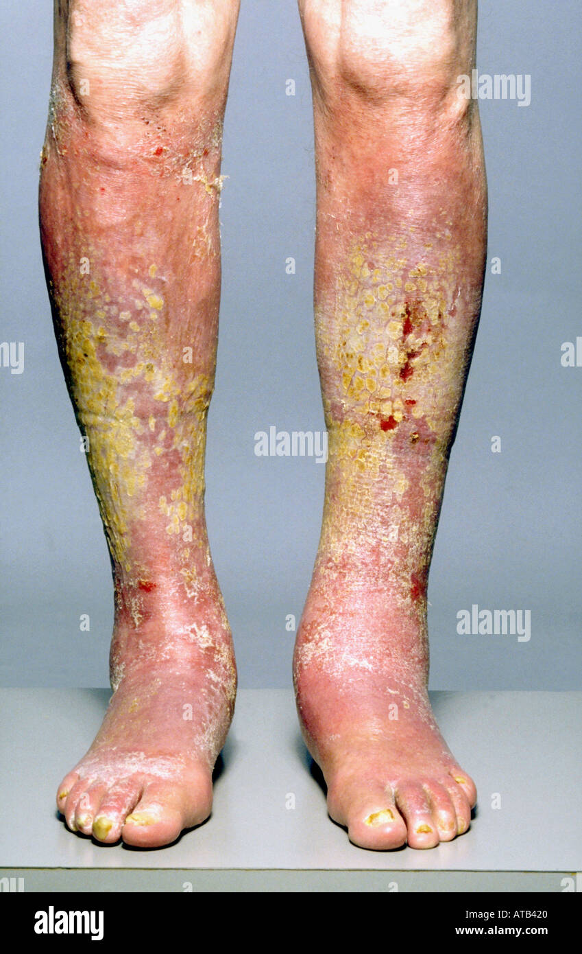 Leg ulcers Stock Photo