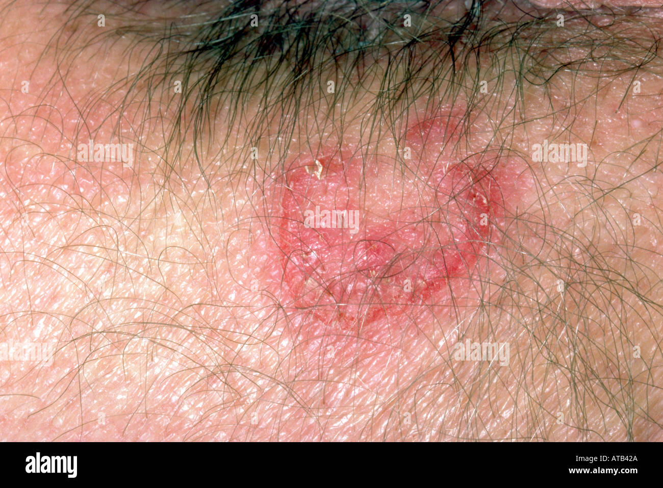 Staphylococcus Aureus Rash