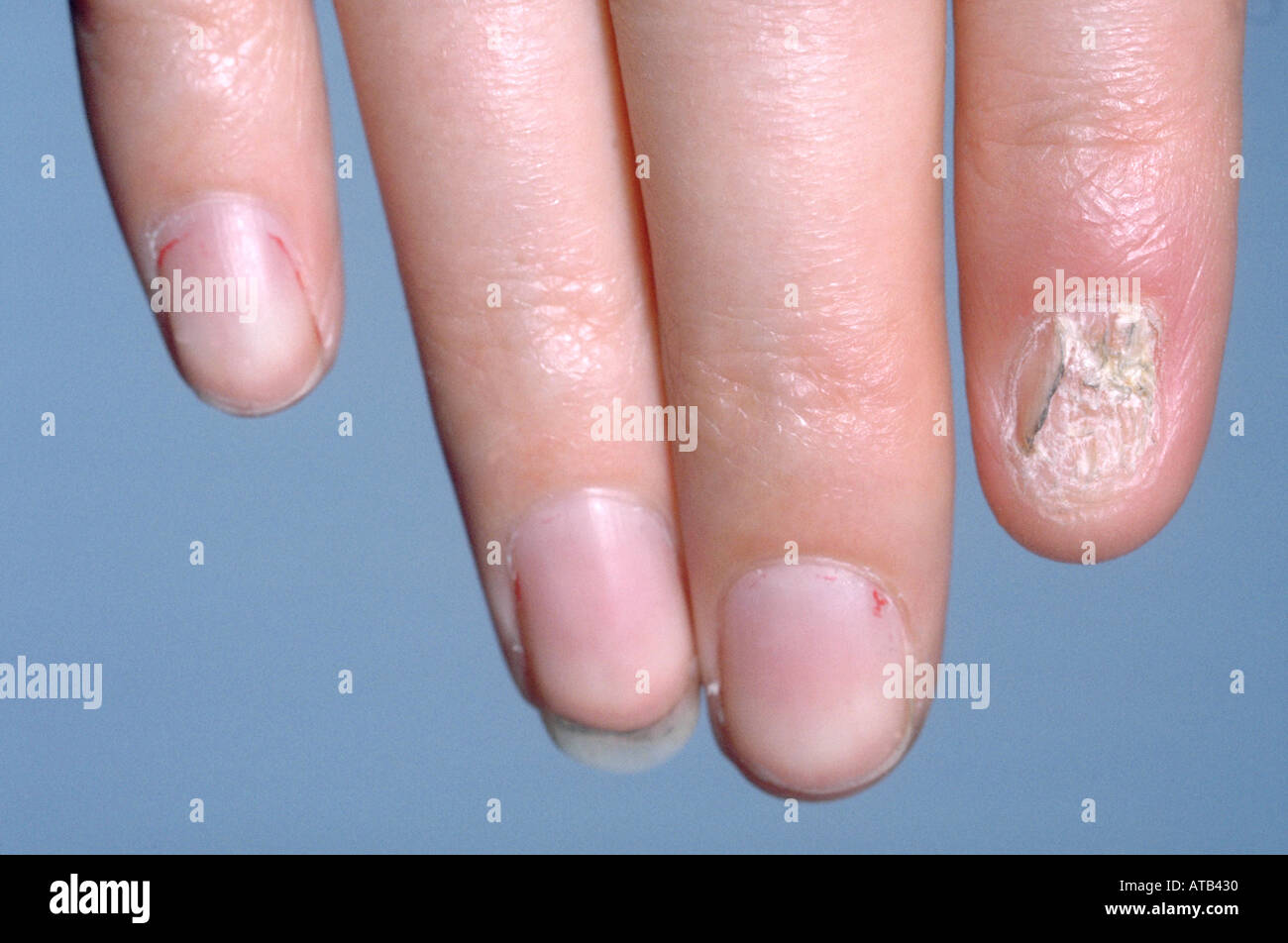 Candidiasis of the fingernails Stock Photo