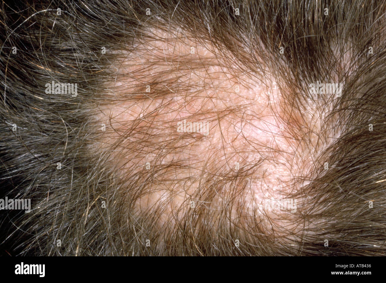 Ringworm scalp hi-res stock photography and images - Alamy