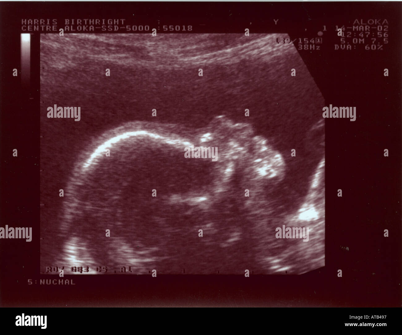 Ultrasound scan 20 weeks normal face Stock Photo Alamy