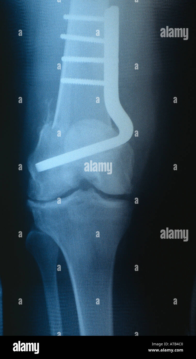 X ray supracondylar femur fracture with blade plate Stock Photo