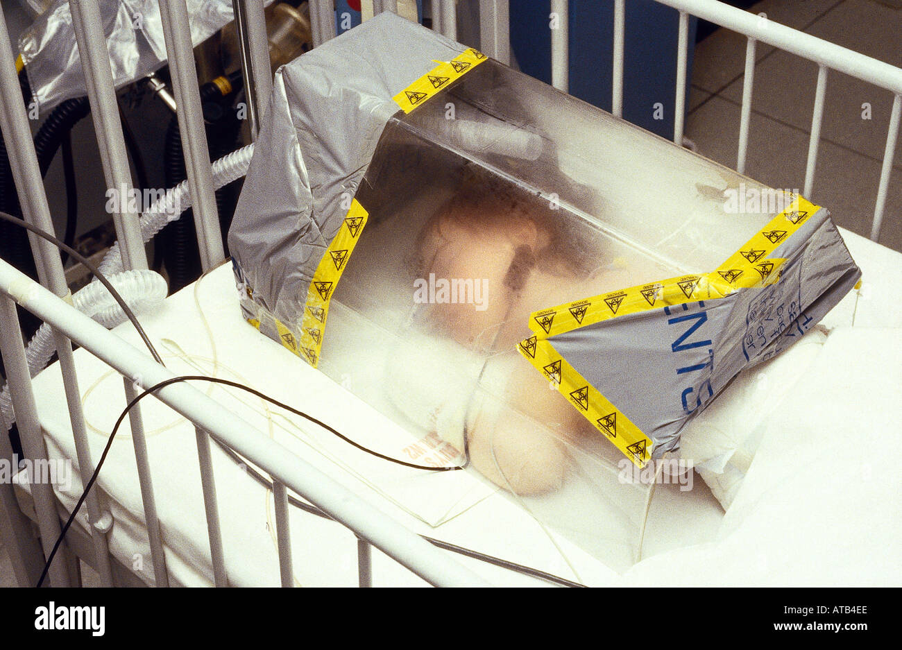 Child in oxygen mist tent for acute epiglottitis Stock Photo 1684717