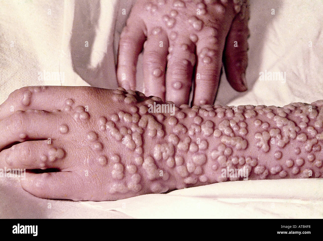 Smallpox Variola virus after 10 days Stock Photo: 1684727 - Alamy