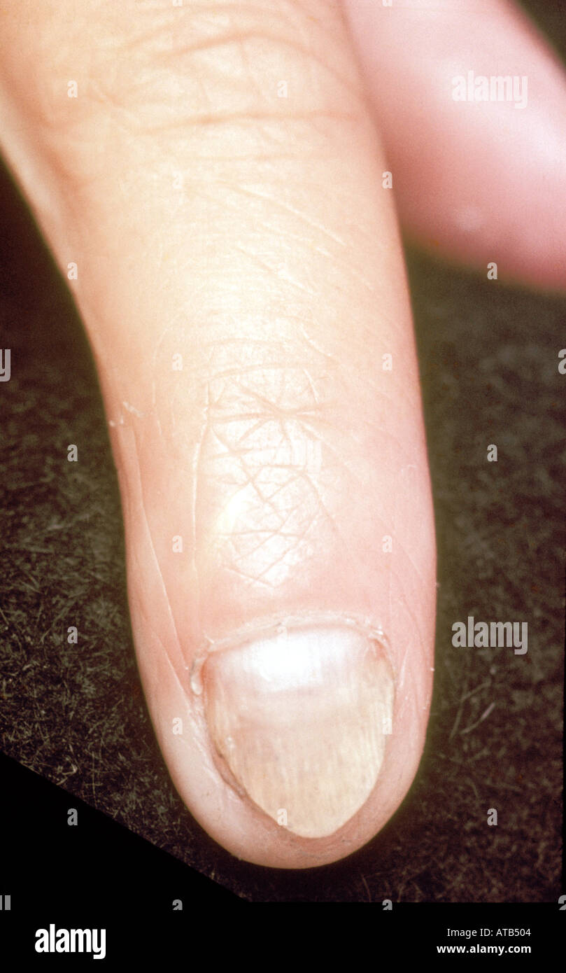 Onycholysis separation of fingernail from nail bed Stock Photo