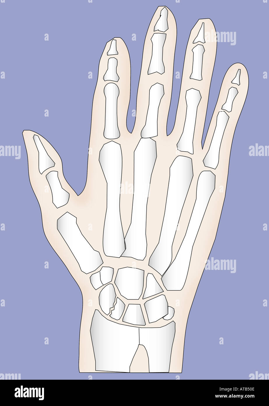 Diagram scaphoid fracture Stock Photo