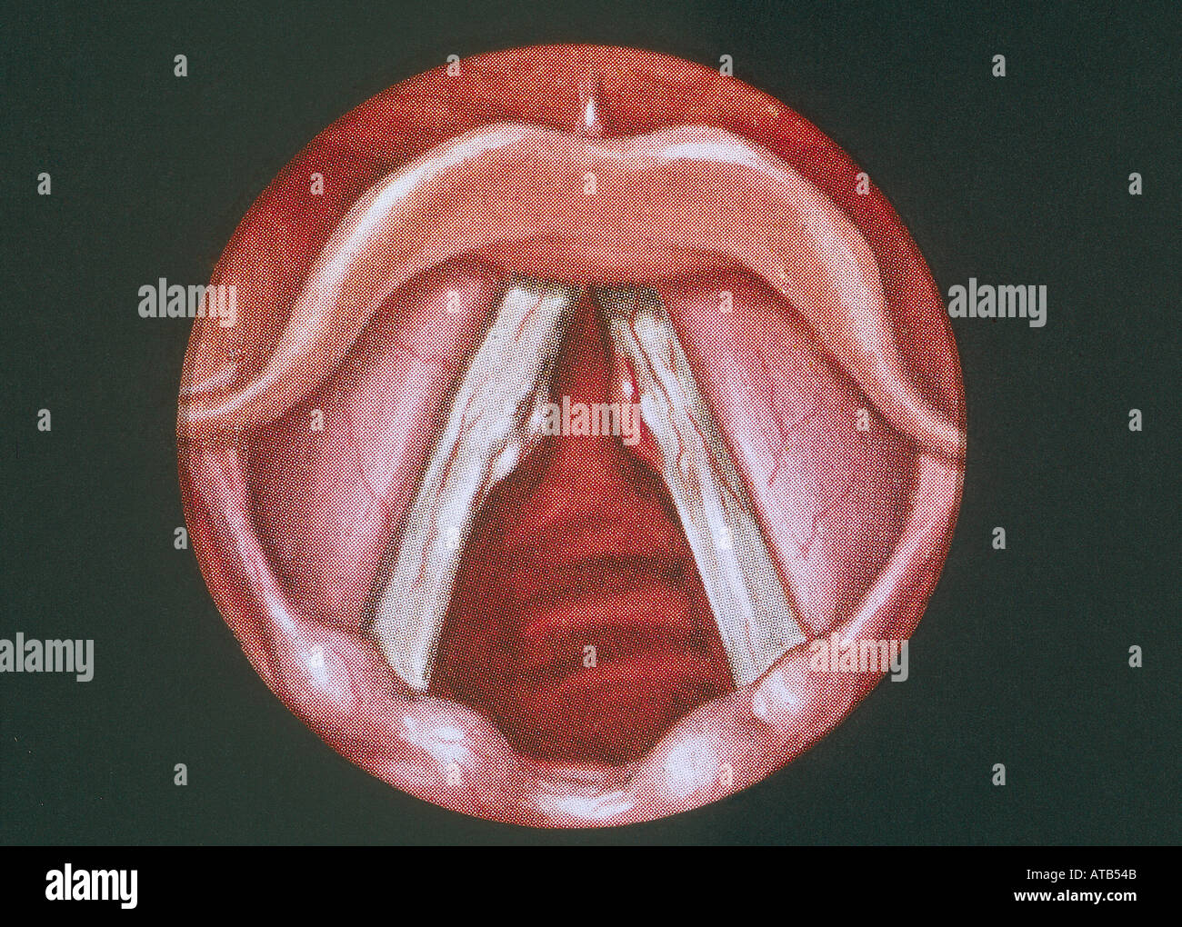 Diagram vocal cord nodules Stock Photo - Alamy