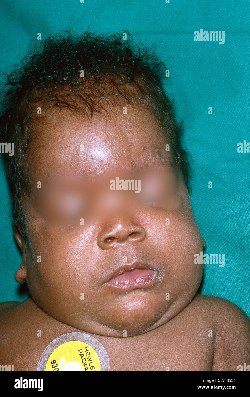 Fetal alcohol syndrome Stock Photo