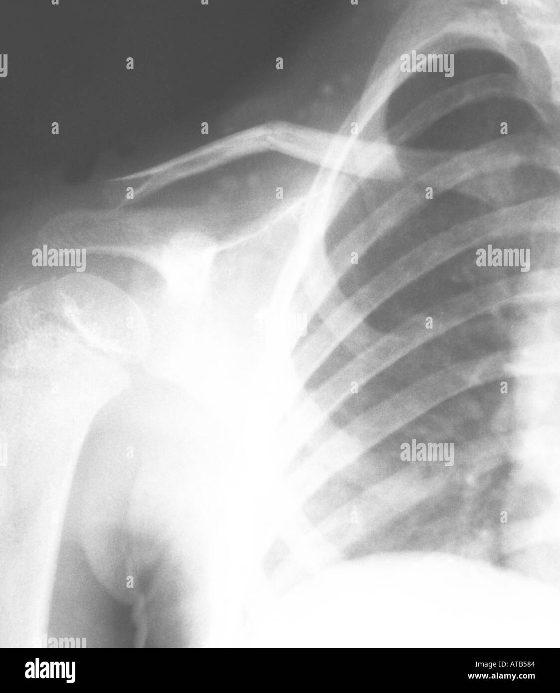 Clavicular High Resolution Stock Photography and Images Alamy
