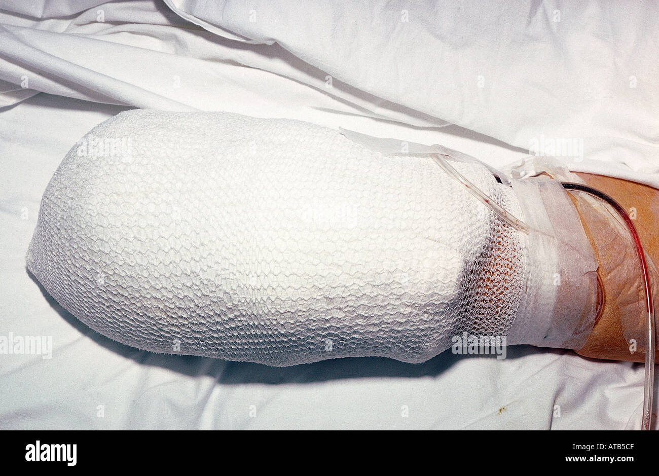 Below knee amputation dressing Stock Photo Alamy