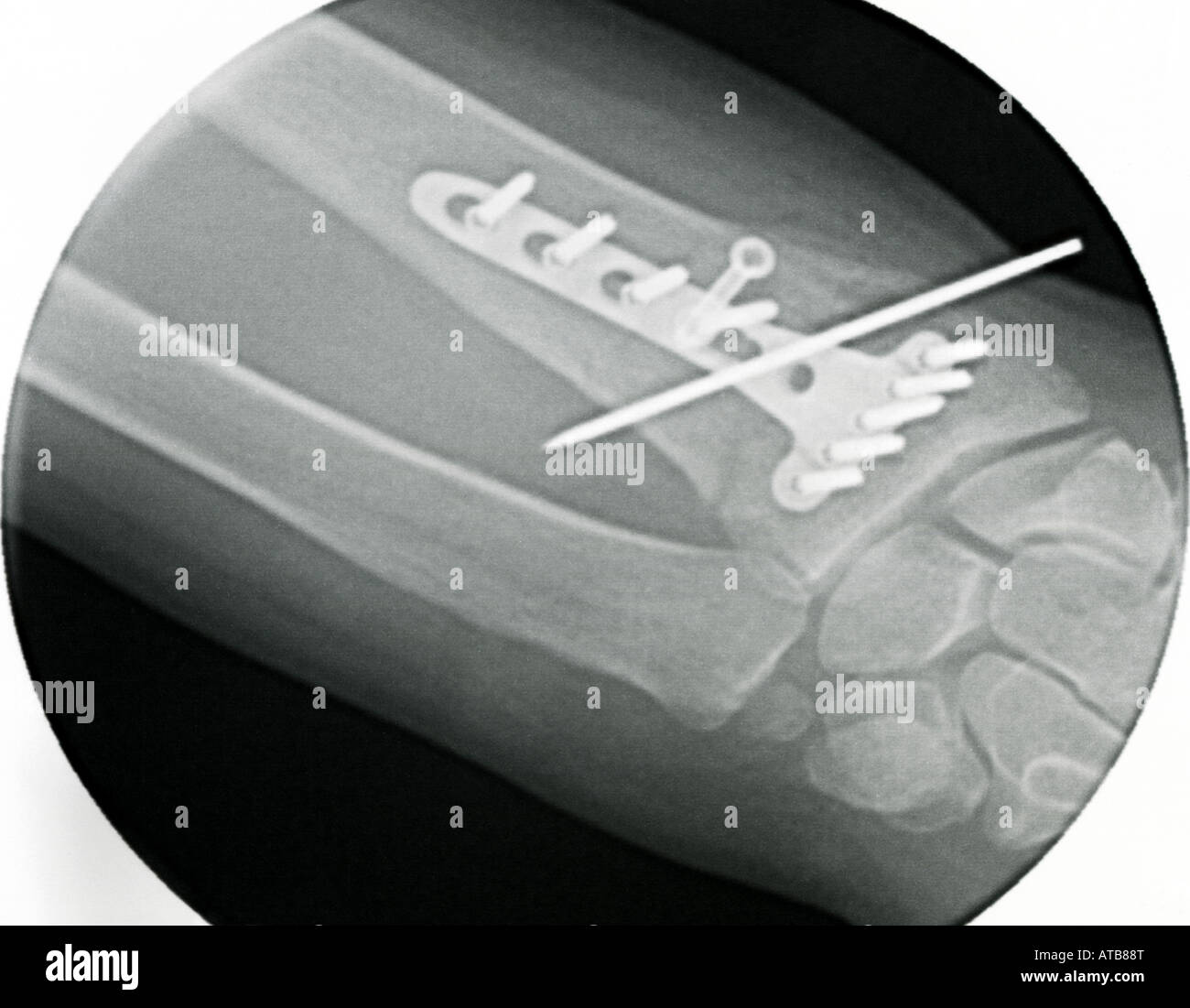 Fractured wrist hires stock photography and images Alamy