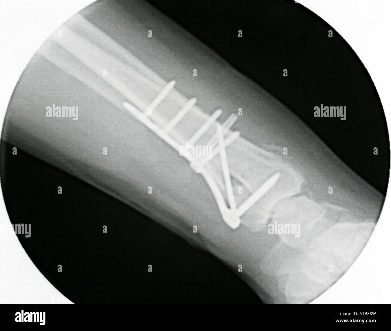 X ray photograph of a fractured wrist hires stock photography and