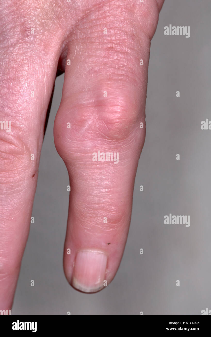 Swollen fingers hires stock photography and images Alamy