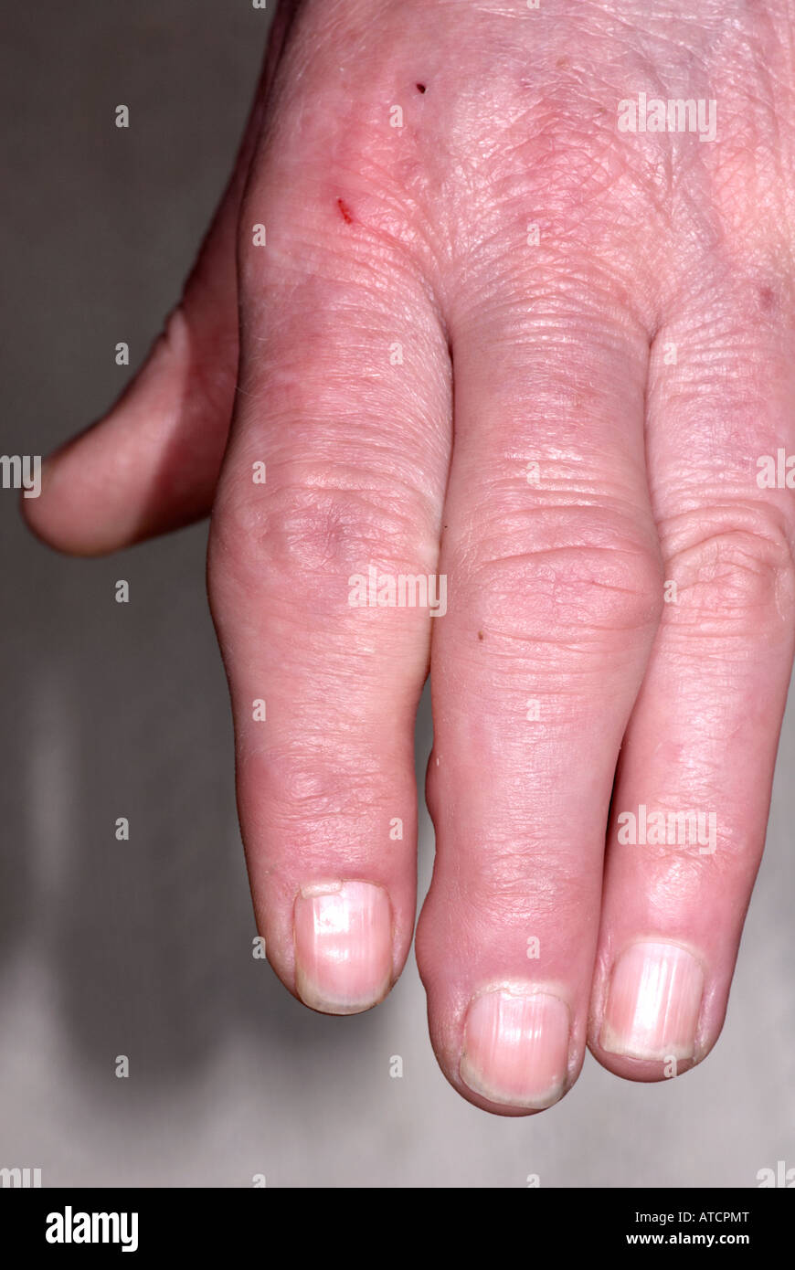 Swollen fingers hires stock photography and images Alamy
