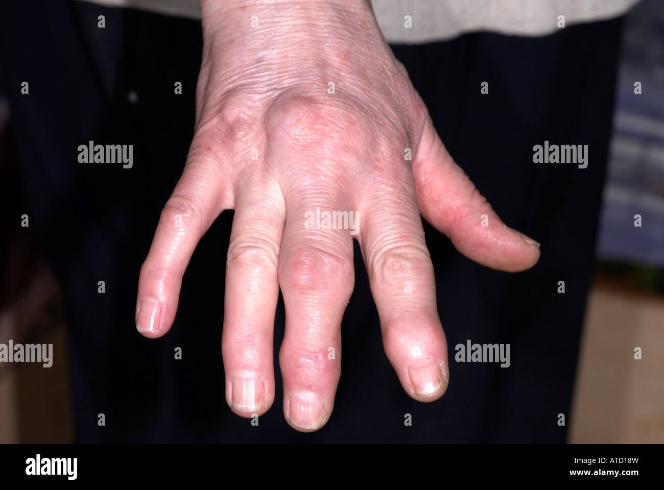 Arthritis on lady's hand showing swollen fingers Stock Photo Alamy