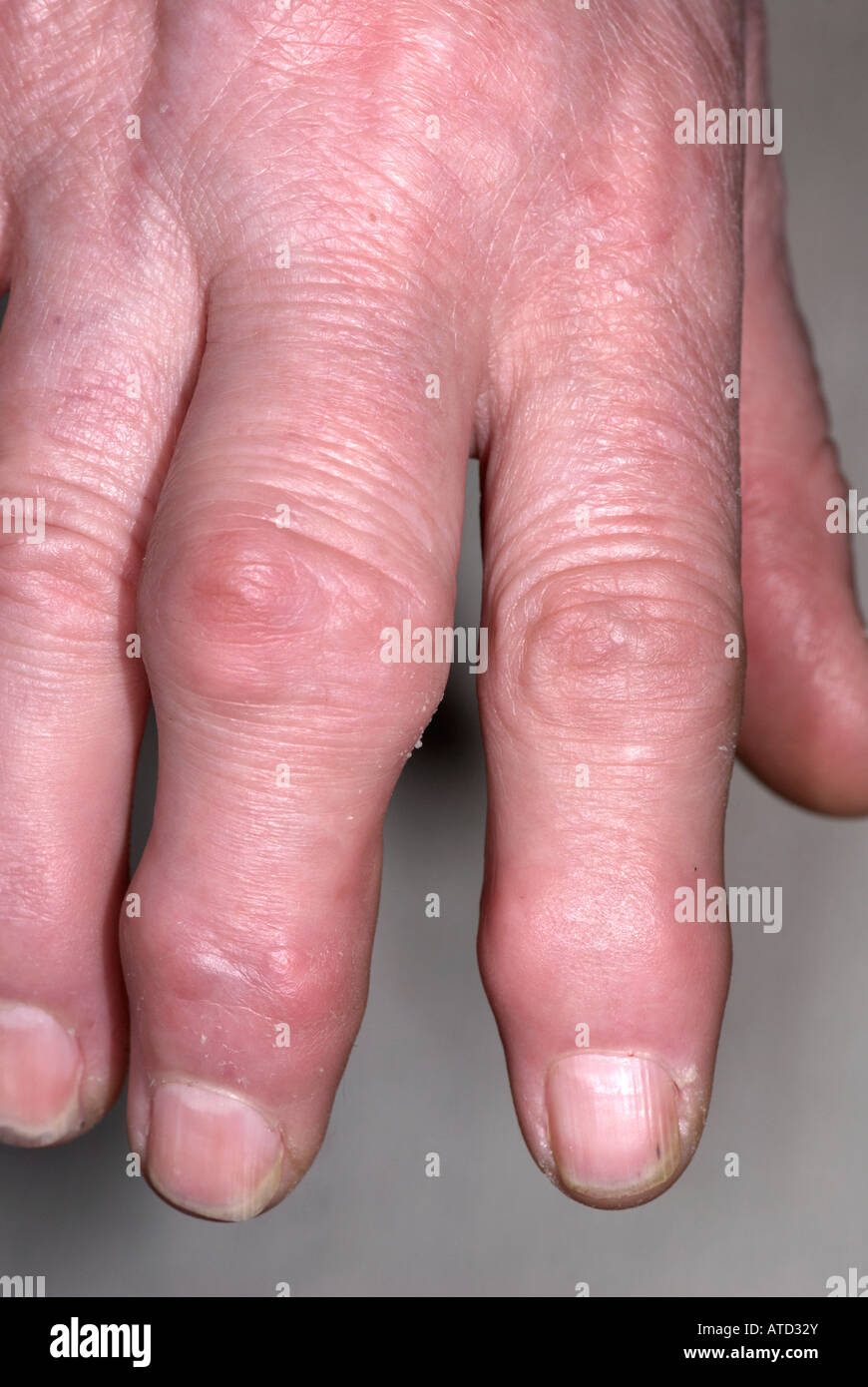 Swollen finger joints hires stock photography and images Alamy