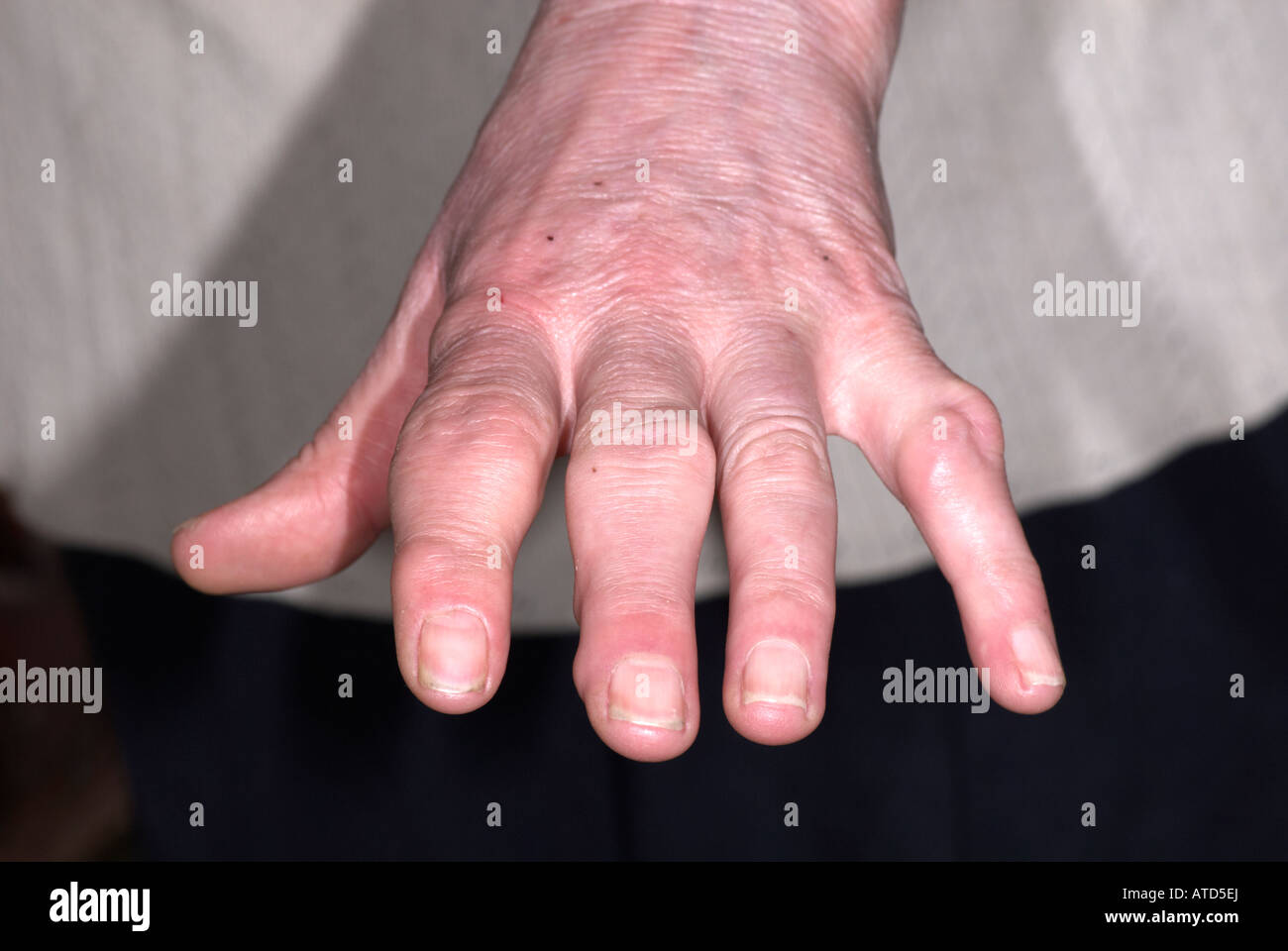 Swollen finger joints hires stock photography and images Alamy