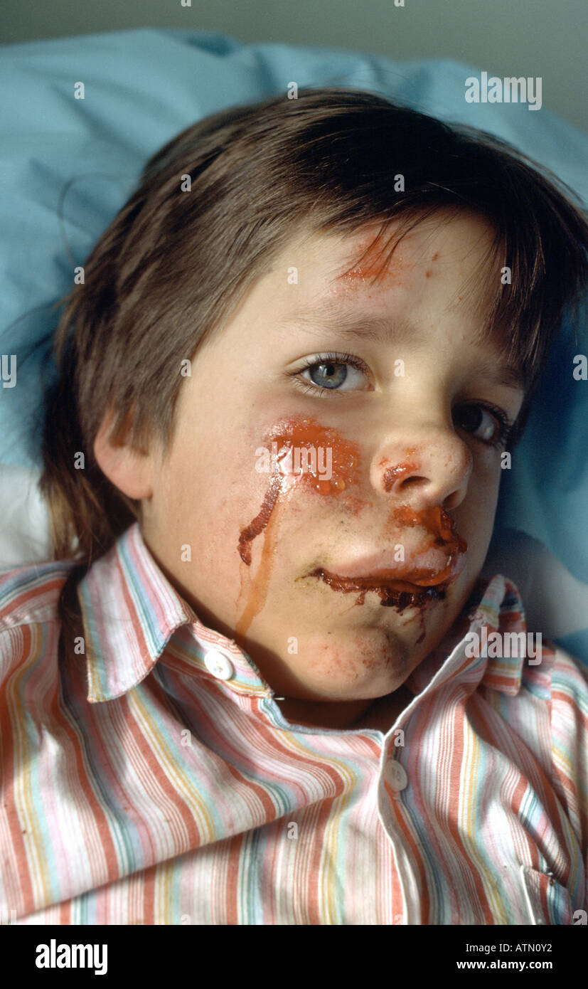 young child's bleeding and swelling face caused by coming over her handle bars on her bicycle Stock Photo