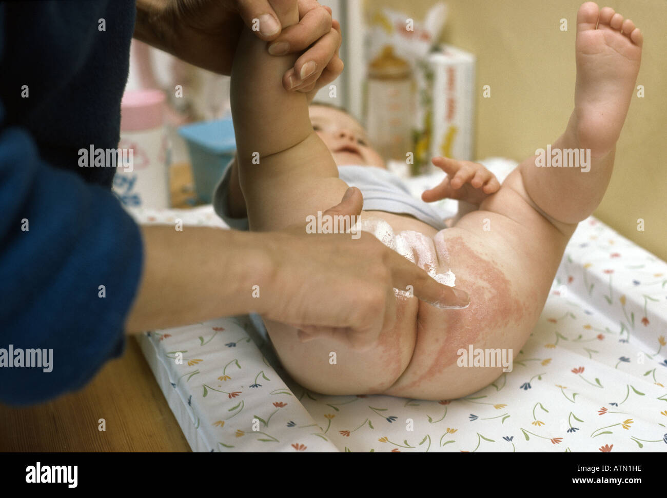 child suffering from nappy rash Stock Photo
