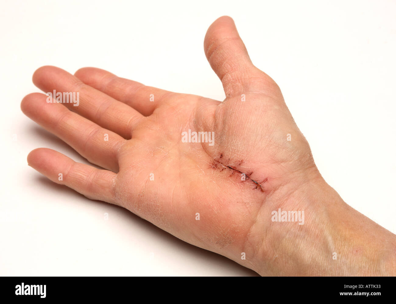 Surgery stitched carpal tunnel operation site two weeks after surgery Stock Photo
