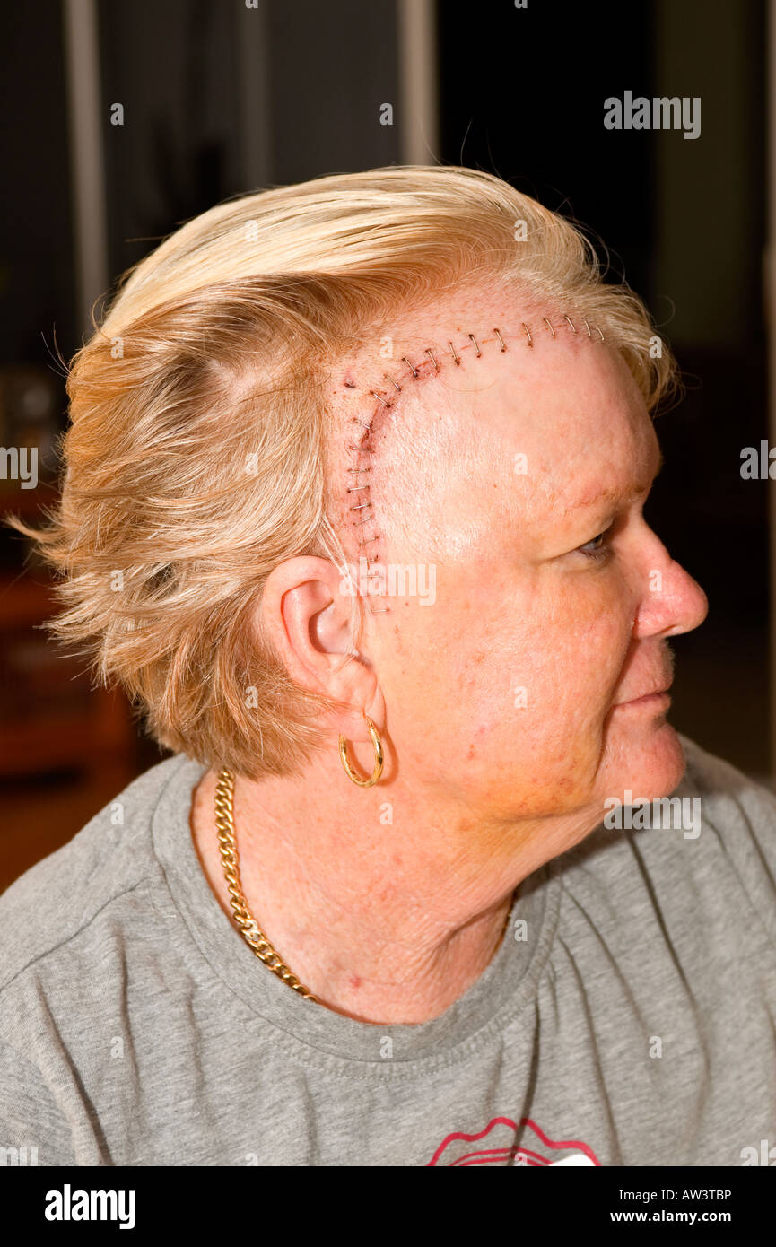 ladys head after undergoing brain surgery Stock Photo - Alamy