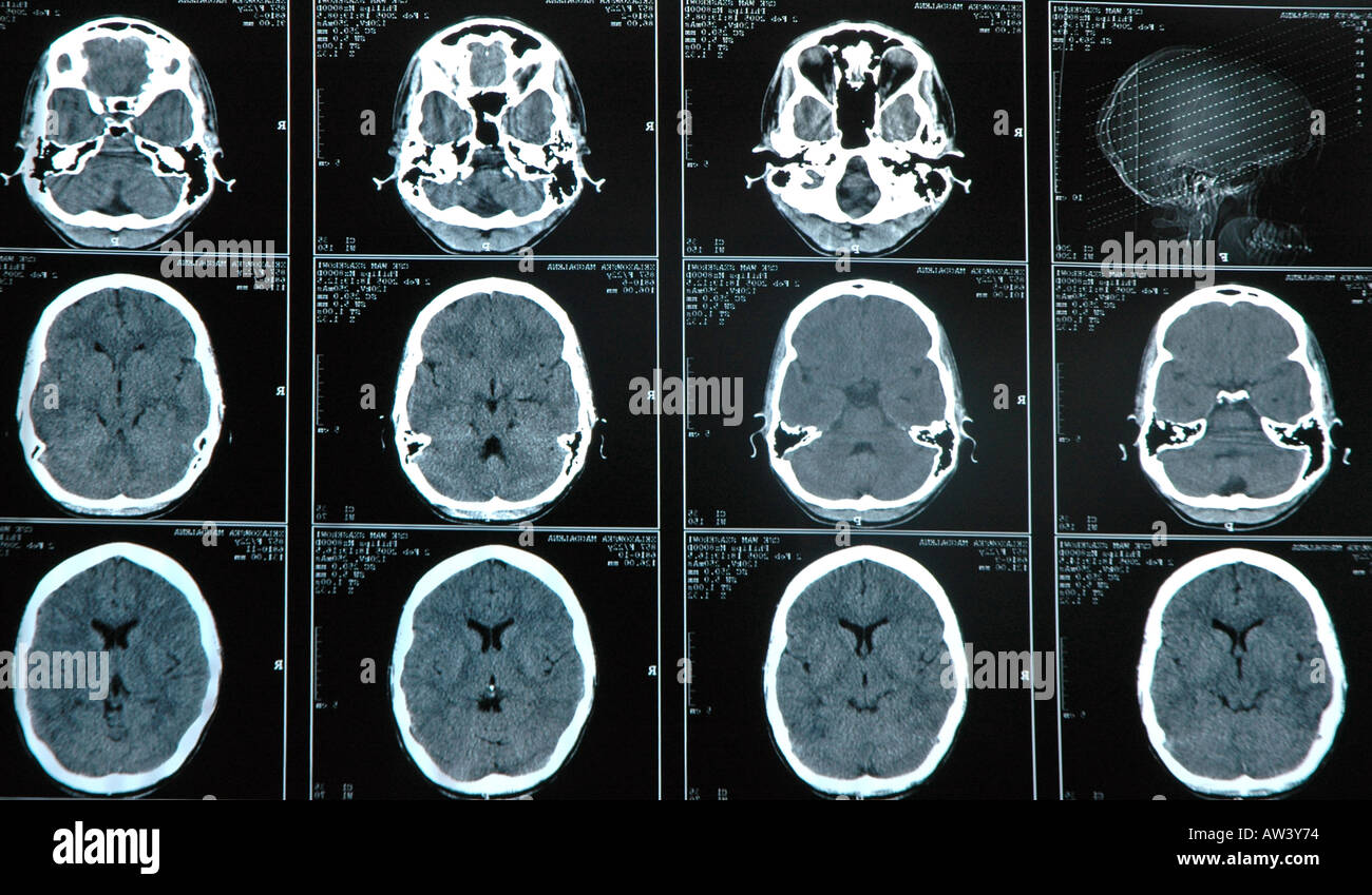 computer tomography CT photography of human brain Stock Photo