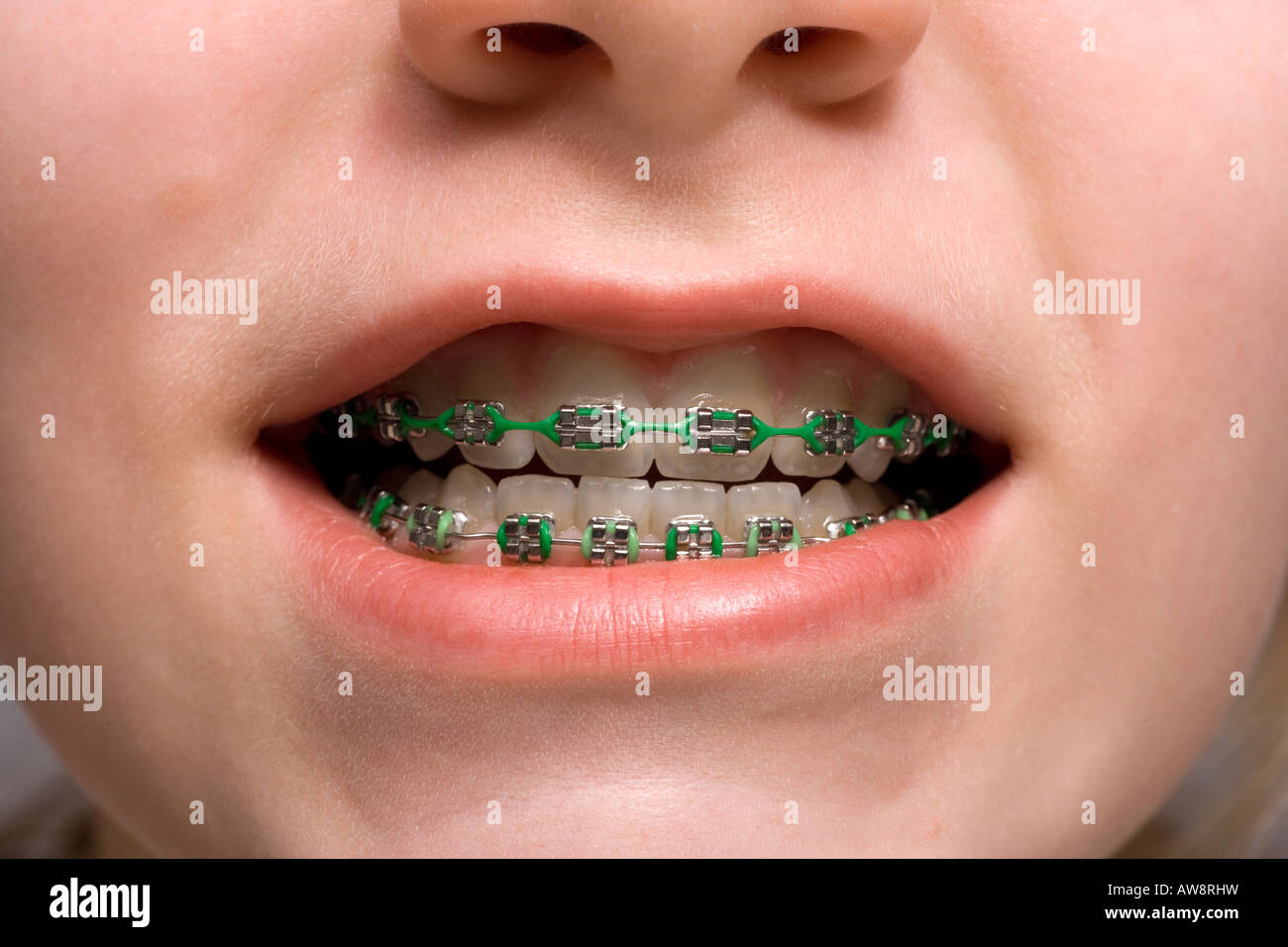 BRACES Stock Photo