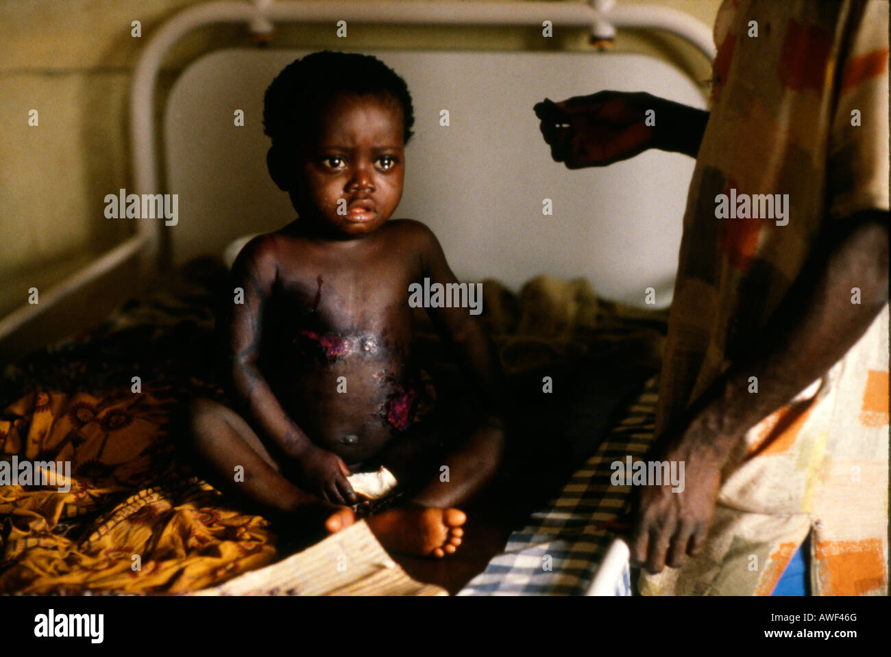 Young child with skin lesions in hospital in Kumasi Ghana West Africa Stock Photo