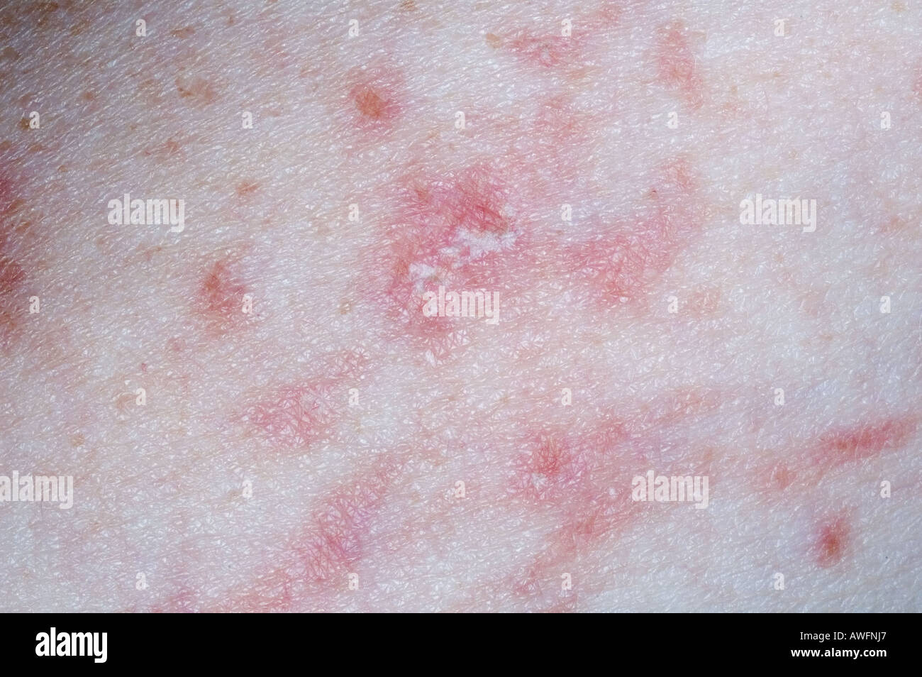 Eczema illustrating the Koebner Phenomenon Stock Photo - Alamy