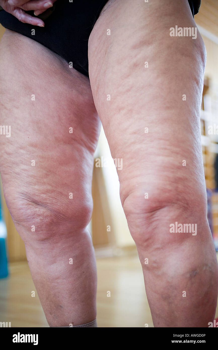 Heavy clearance cellulite thighs