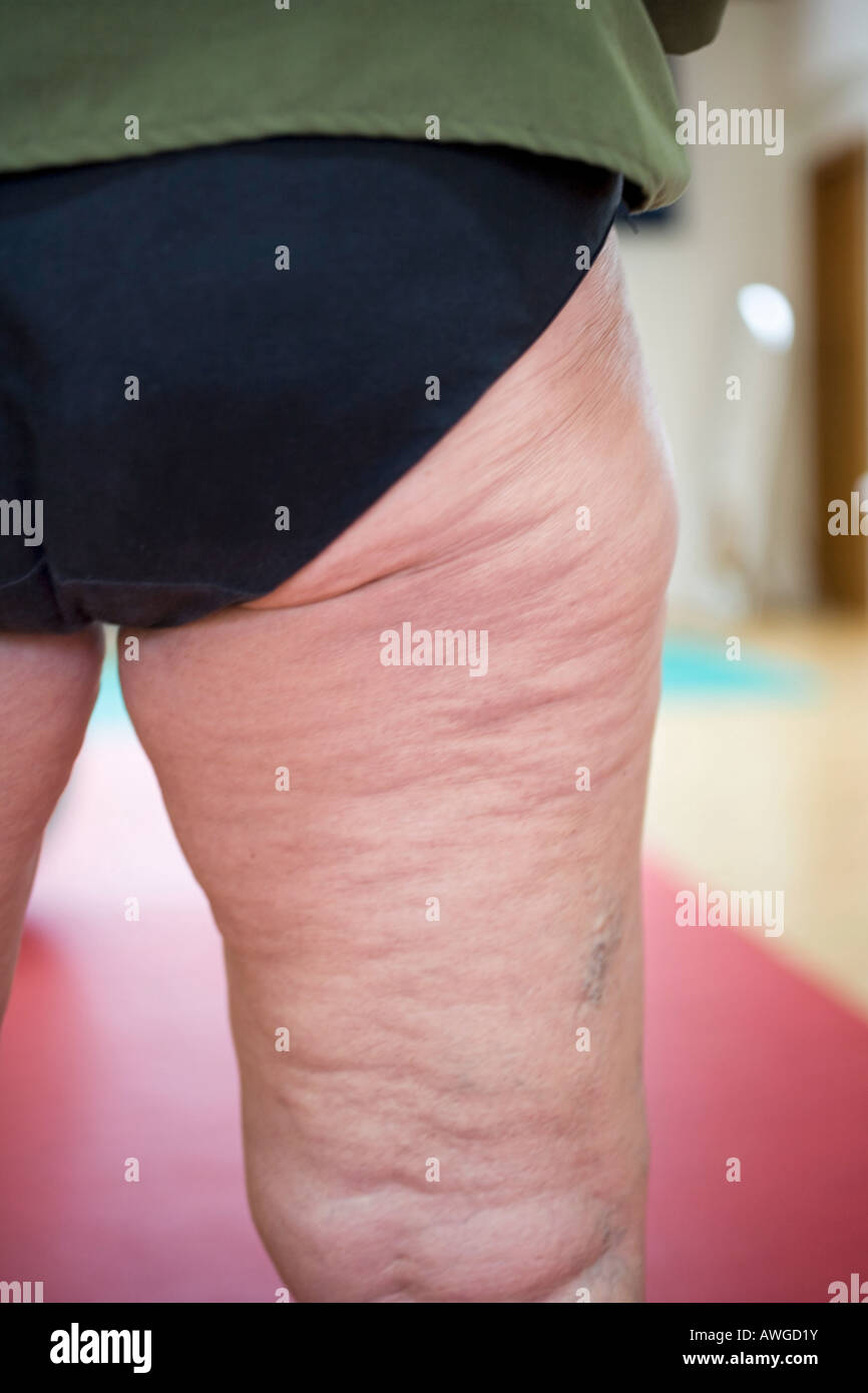 Cellulitis Leg Hi-res Stock Photography And Images - Alamy