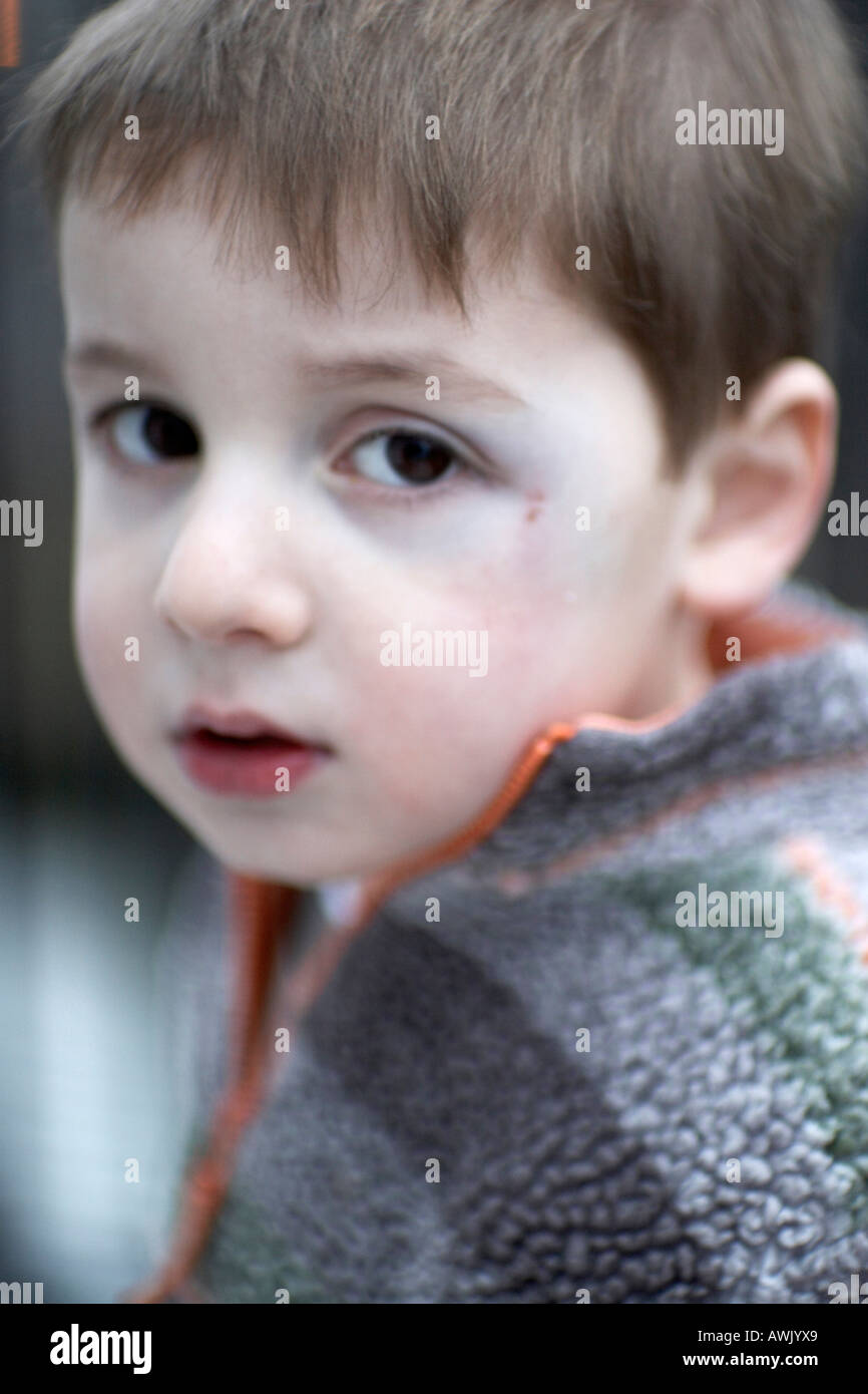 Young boy child with bruise injury near his eye looking hurt sad