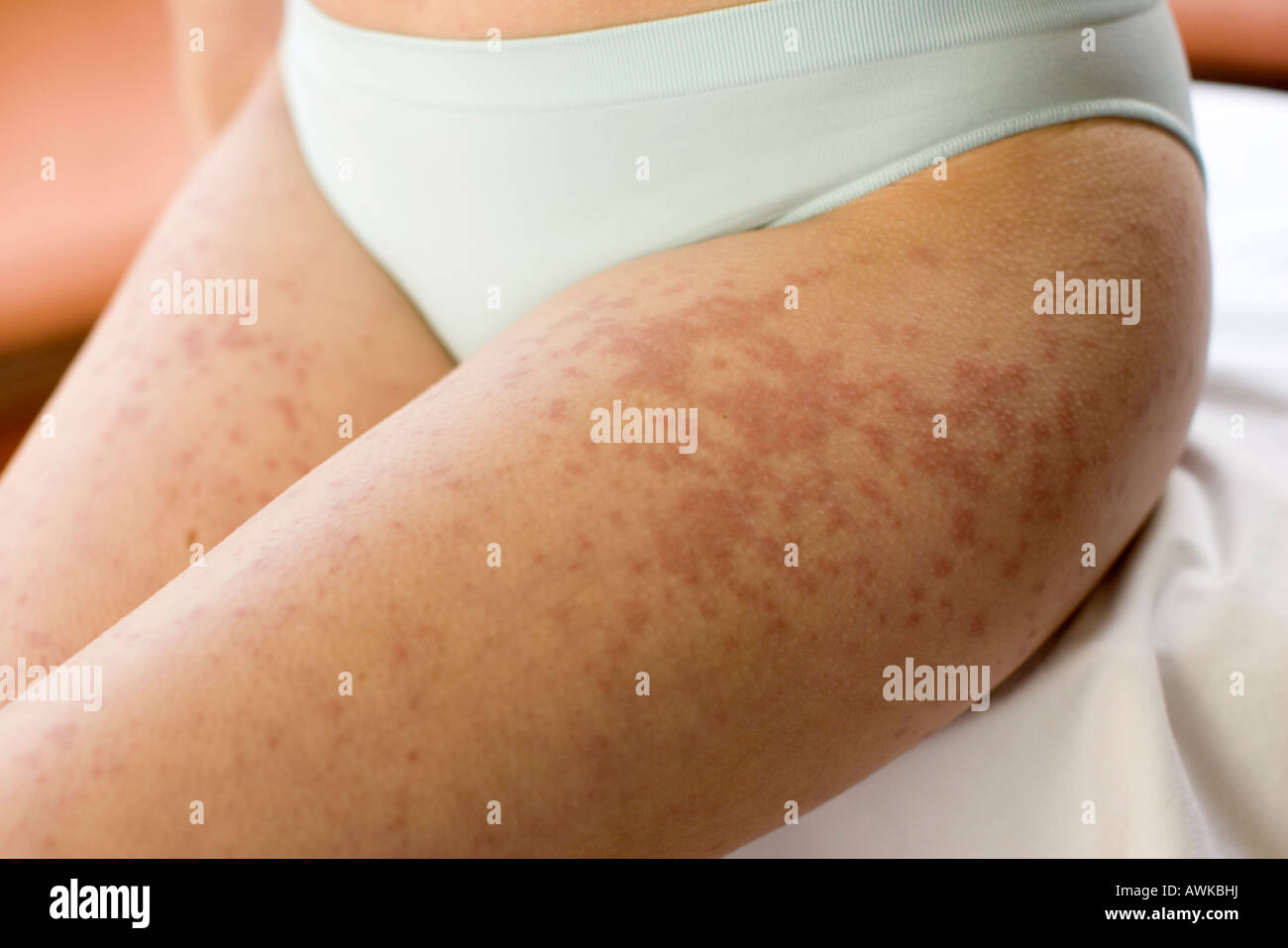 woman with rash on her legs Stock Photo