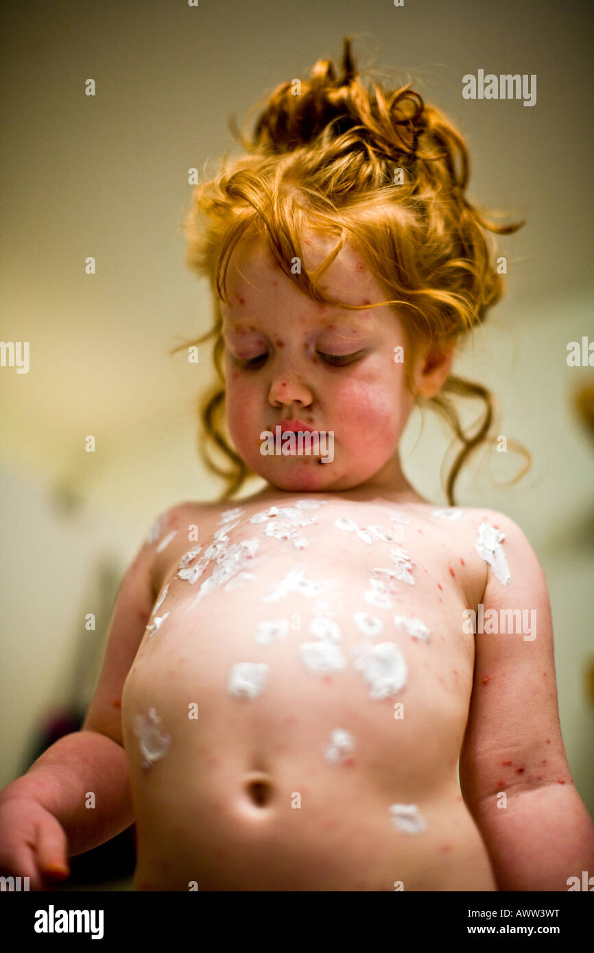 Redhead three year old girl with chicken pox inspecting her spots Stock Photo