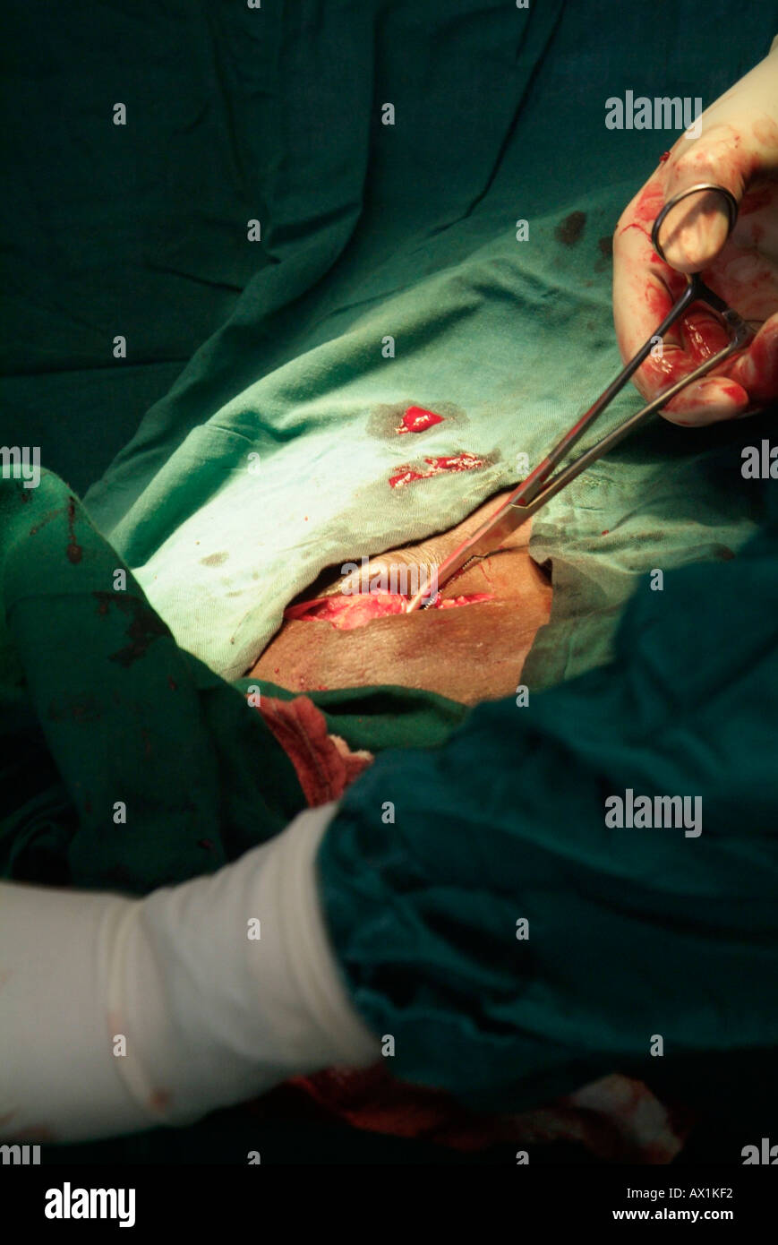 Femoral Hernia - Alpine Surgical Practice, Colorectal Surgeon, Lipoma  Removal