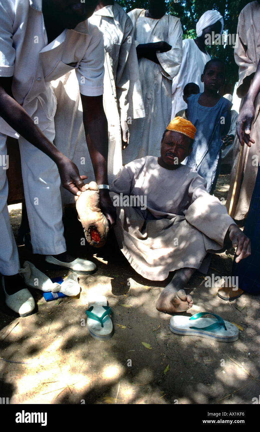 El Geneina Sudan Nurse Tending Lepers To Clean Wound  Soap & Water Stock Photo
