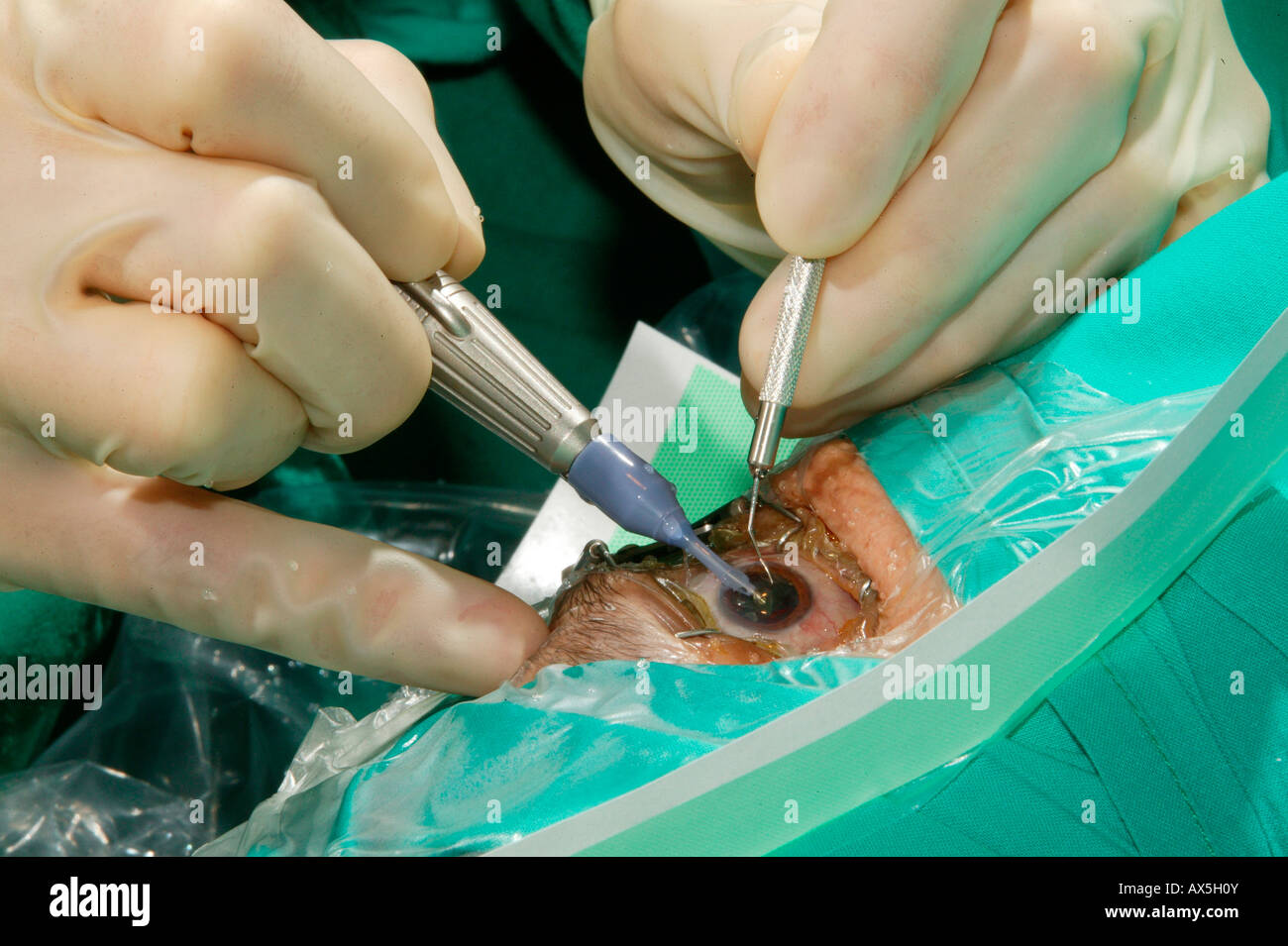 Cataract surgery performed in an operating room in Pietermaritzburg, South Africa, Africa Stock Photo