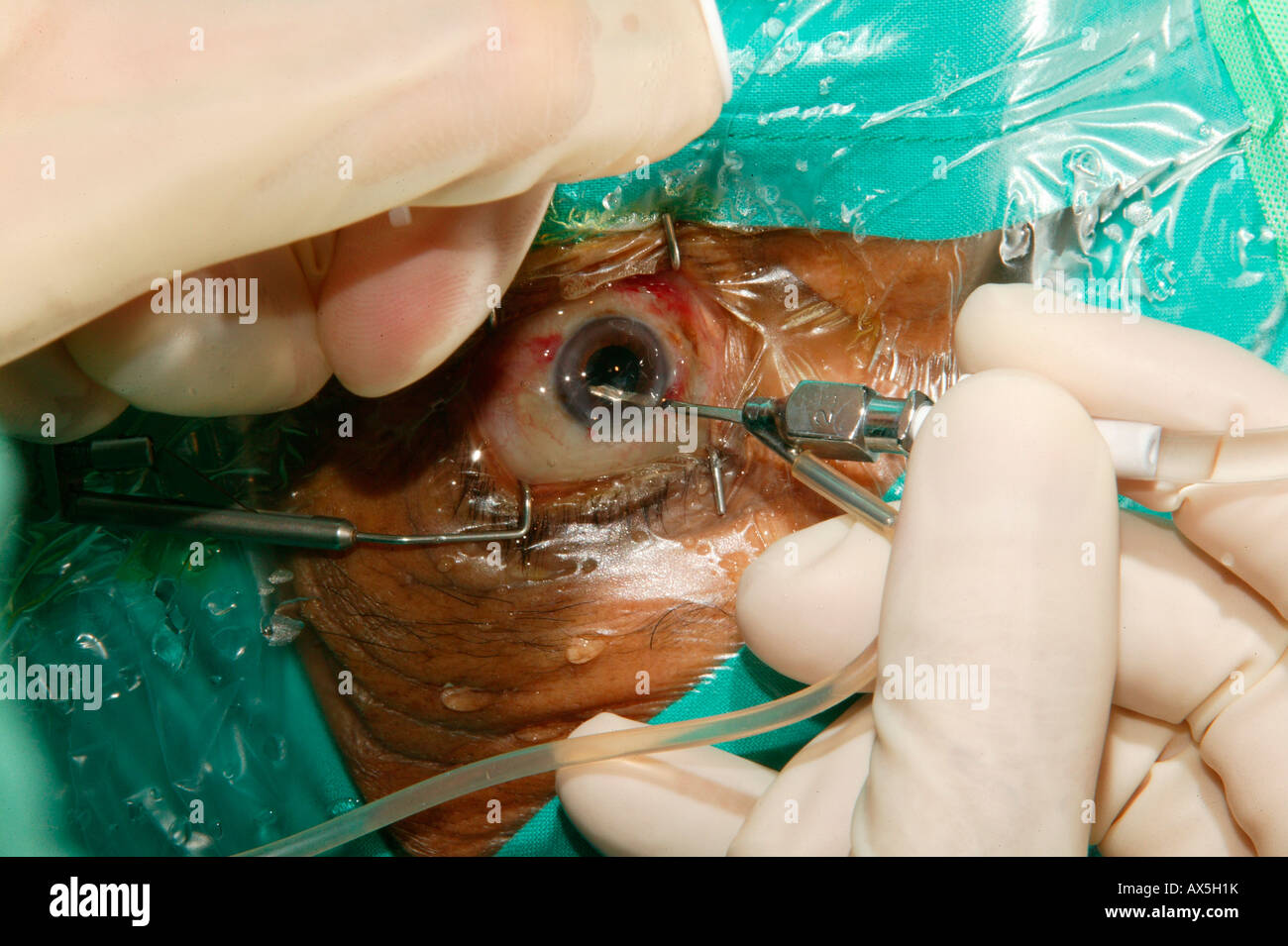 Cataract surgery performed in an operating room in Pietermaritzburg, South Africa, Africa Stock Photo