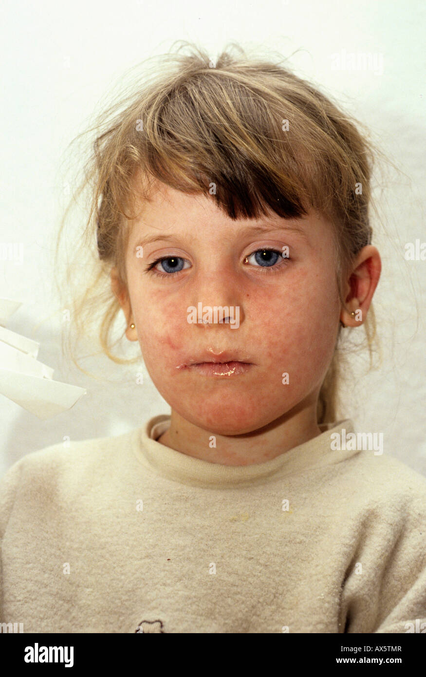 Girl suffering from measles (rubeola) Stock Photo
