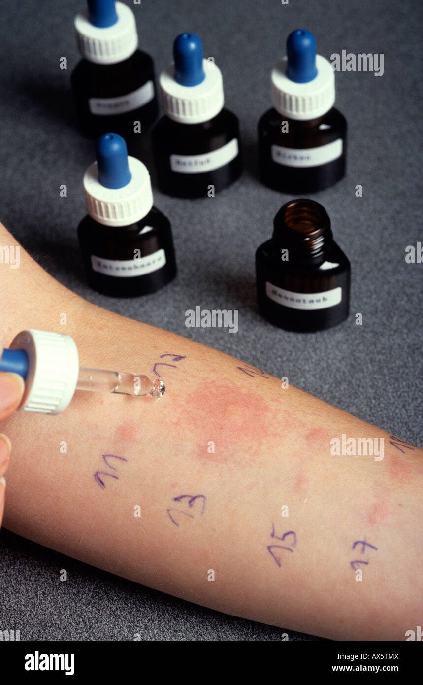 Allergy test Stock Photo