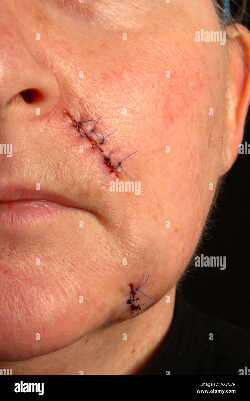 Scars and stitches on a womans face after cosmetic surgery. Stock Photo