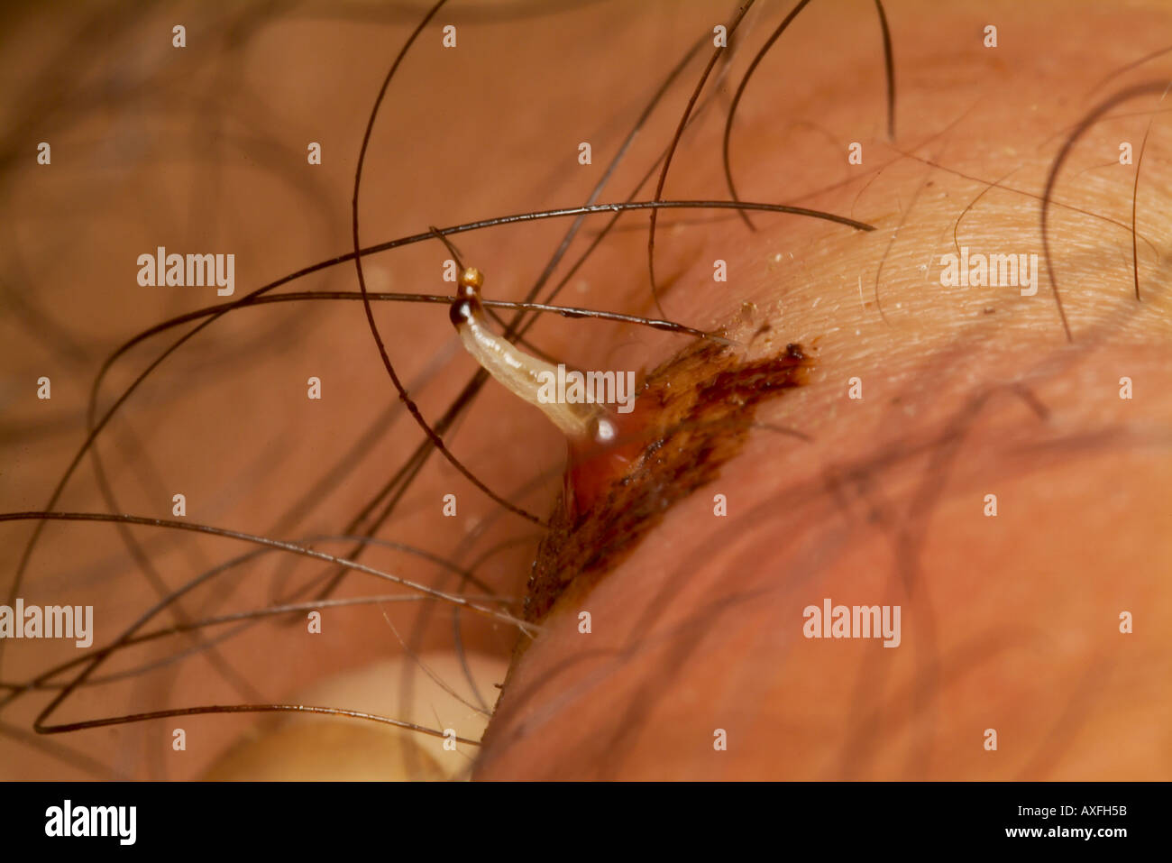 https://c8.alamy.com/comp/AXFH5B/human-botfly-part-removed-from-host-person-dermatobia-hominis-amazonian-AXFH5B.jpg