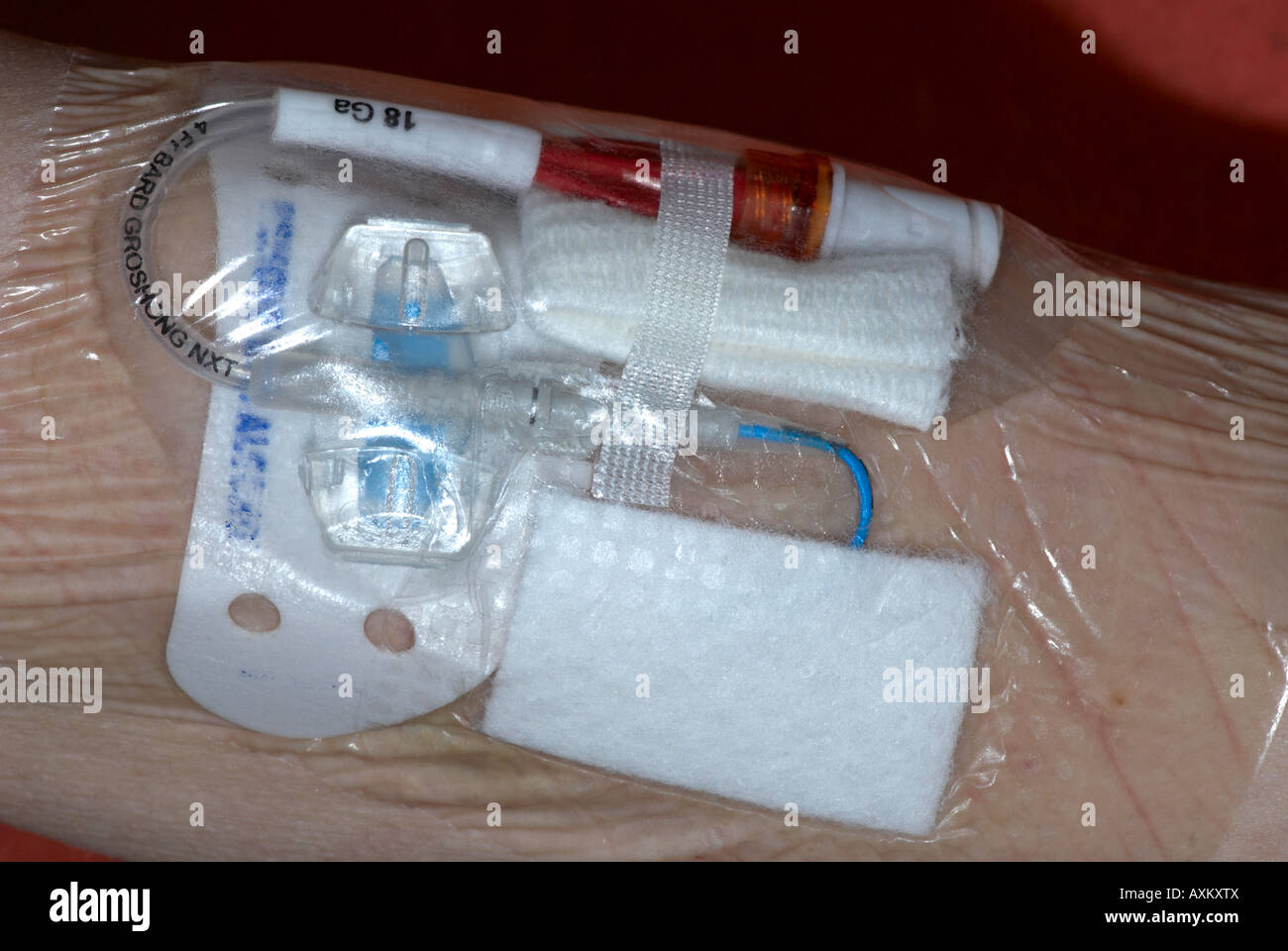 Picc line in arm of female cancer patient - peripherally inserted ...