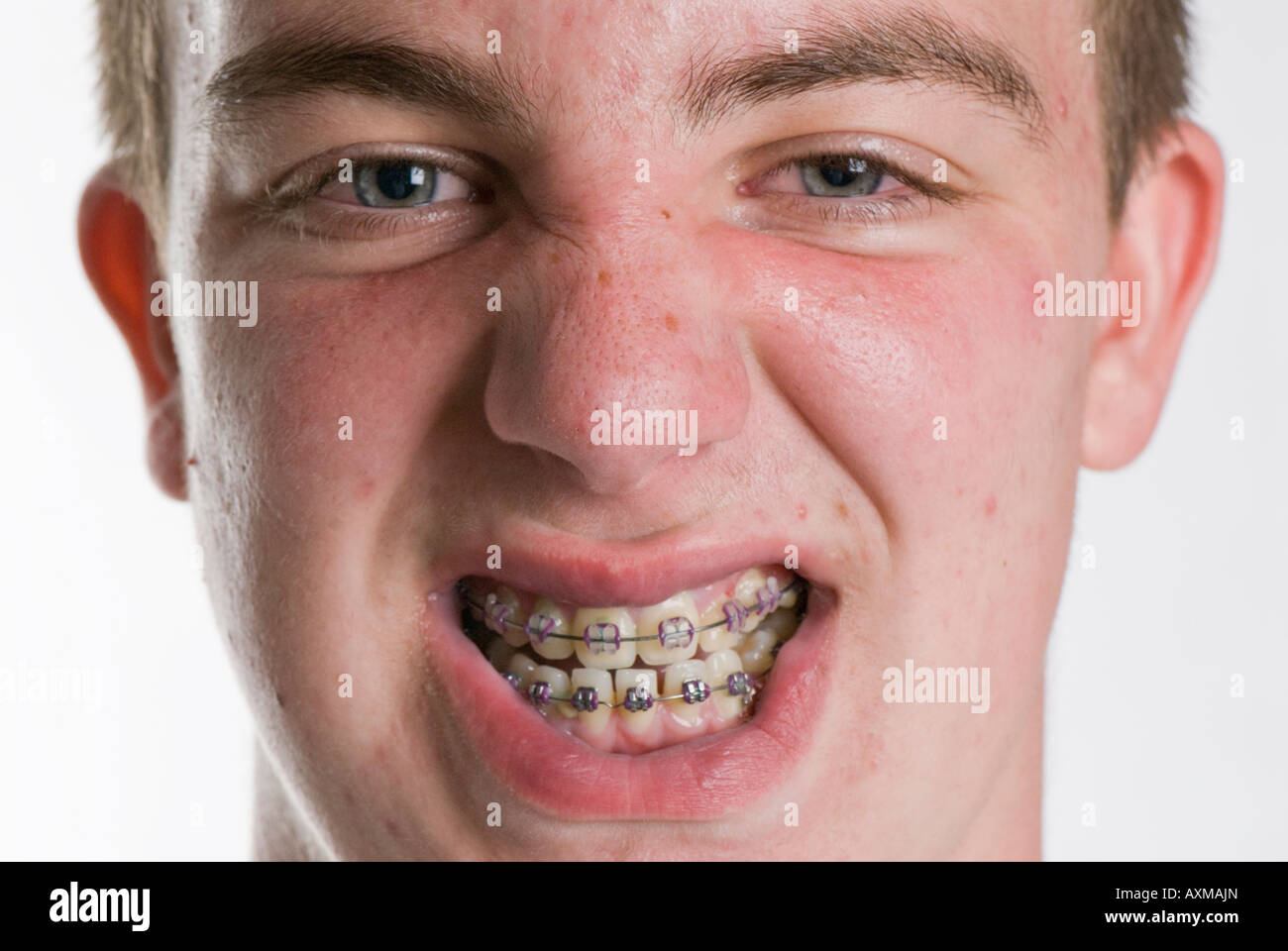 Teenage boy with acne and braces Stock Photo