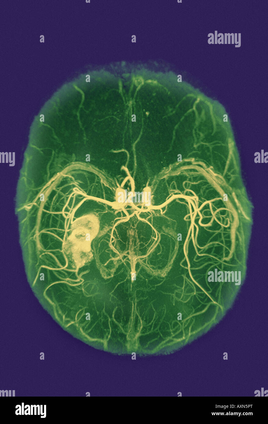 x ray of brain showing hemorrhage blood clot brain attack Stock Photo