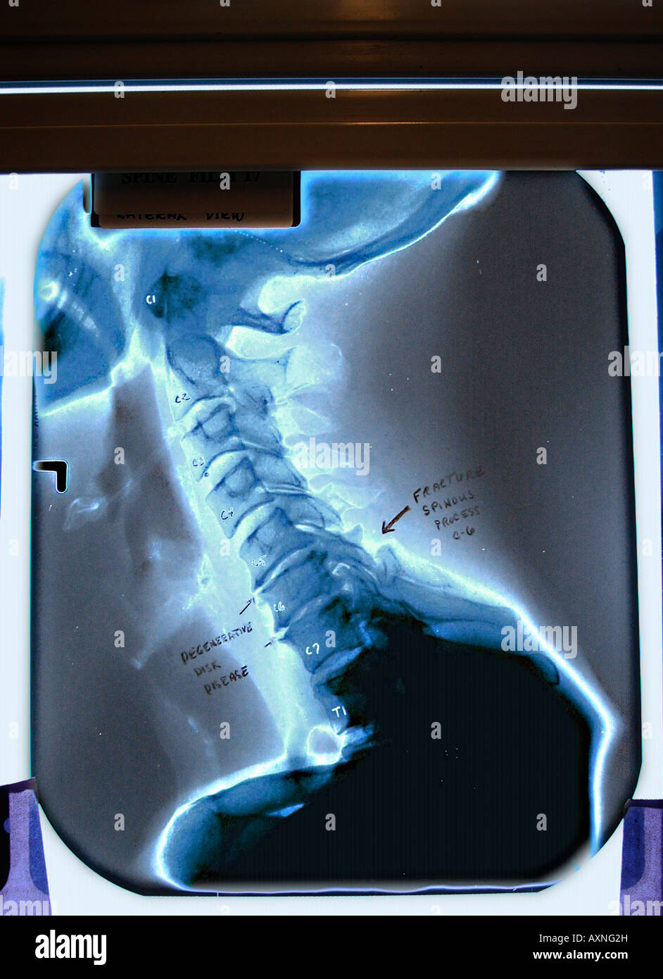 x ray of scull and neck Stock Photo